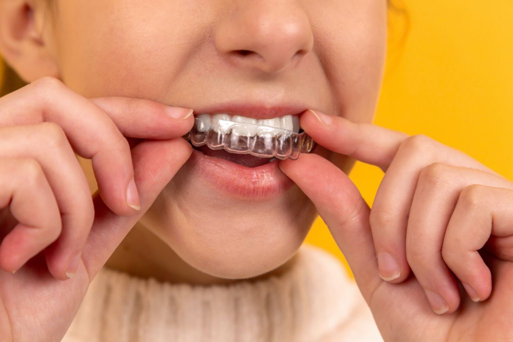 Invisalign is an increasingly popular orthodontic treatment– and with good reason! Invisalign allows wearers to straighten teeth discreetly and conveniently, with much fewer trips to the orthodontist.