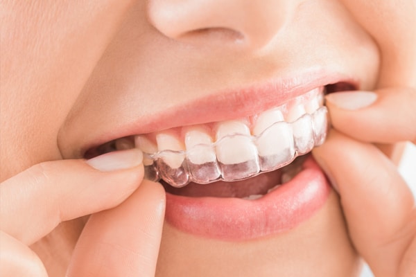 Invisalign is an increasingly popular orthodontic treatment– and with good reason! Invisalign allows wearers to straighten teeth discreetly and conveniently, with much fewer trips to the orthodontist.